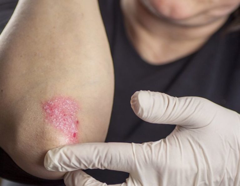 Targeting A Skin Protein May Reduce The Severity Of Psoriasis Study